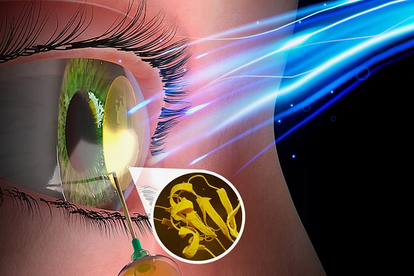 Po vstreknutí do chirurgicky vytvorenej kapsy v rohovke sa biomateriál po vystavení modrému svetlu s nízkou energiou sformuje do priehľadnej 3D štruktúry podobnej rohovkovému tkanivu.