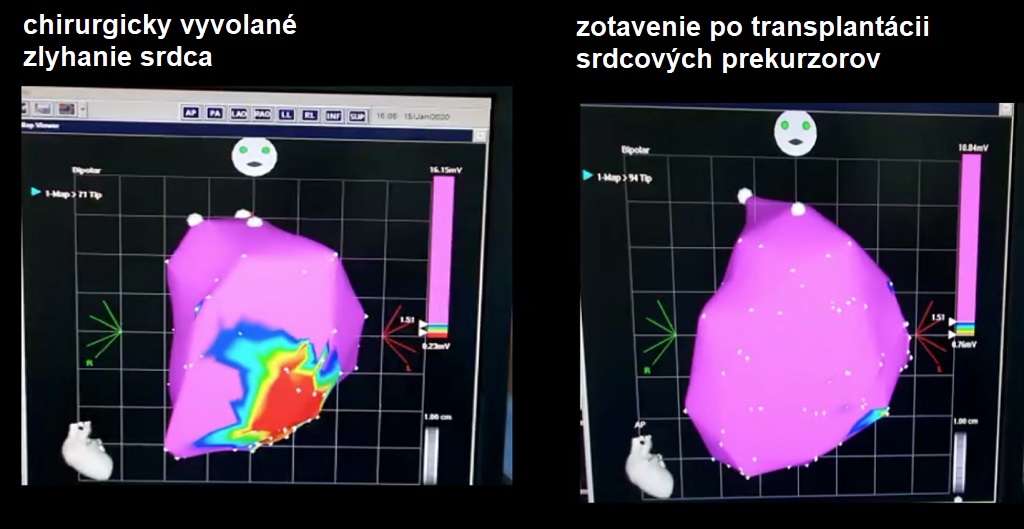 Elektroanatomické mapy prasacieho srdca pred a po transplantácii prekurzorových kmeňových buniek. Oblasti vo fialovej farbe predstavujú zdravé tkanivo, zatiaľ čo oblasti v iných farbách zobrazujú poškodené tkanivo. Elektroanatomické mapy prasacieho srdca pred a po transplantácii prekurzorových kmeňových buniek. Oblasti vo fialovej farbe predstavujú zdravé tkanivo, zatiaľ čo oblasti v iných farbách zobrazujú poškodené tkanivo.