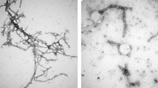 Vľavo: zhluky alfa-synukleínu, ktoré sa môžu hromadiť v mozgu a sú spojené s Parkinsonovou chorobou. Vpravo: tieto zhluky po ošetrení novou liečbou nanotkaninou.