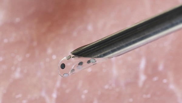 Spolu s chirurgickou implantáciou do tela môže byť nálepka BioSUM tiež vpichnutá pomocou ihly.