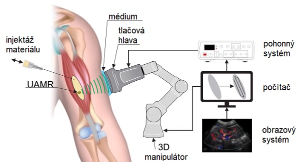 Schéma znázorňuje, ako by sa technika 3D tlače DSP mohla použiť na vytlačenie štruktúry priamo v pacientovej ruke.