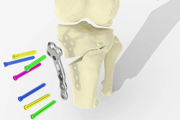 Nová procedúra TOKA bola testovaná pomocou počítačových simulácii zahŕňajúcich skenovanie holenných kostí 28 pacientov.