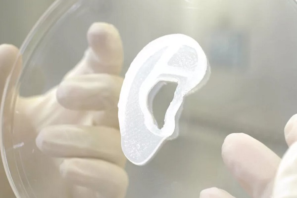 3D biotlačené ucho kultivované z vlastných chrupavkových buniek pacienta.