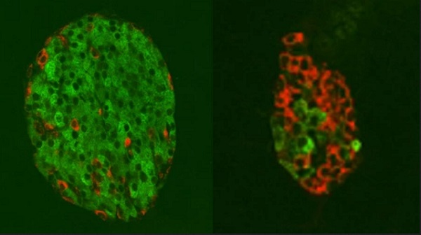 Zdravý ostrovček pankreasu s množstvom buniek produkujúcich inzulín (zlená farba) a buniek produkujúcich glukagón (červená farba) na ľavej strane v porovnaní s diabetickým ostrovčekom pankreasu napravo.