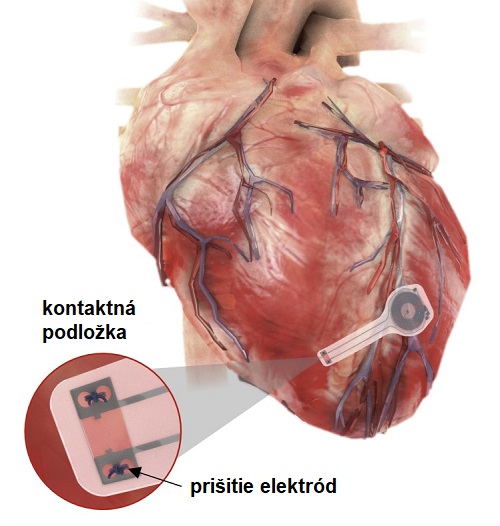 Obrázok ukazuje prvý dočasný kardiostimulátor na svete na povrch srdca.