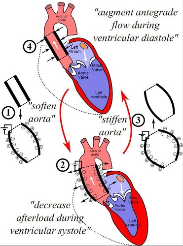 Schéma, ktorá ukazuje, ako funguje nová umelá aorta.