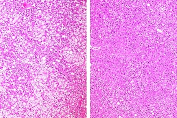 Tukové usadeniny pozorované v bielej farbe v pečeňovom tkanive neliečených myší vľavo, v porovnaní s myšami liečenými ADI-PEG 20 vpravo.