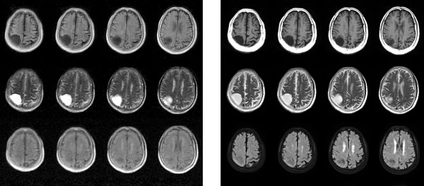 Vľavo: Skenovanie mozgu nádorov pomocou mobilného MRI so silou 0,055 T. Vpravo: Skenovanie pomocou konvenčného 3 T MRI.