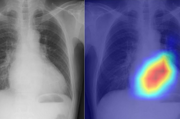 Výskumníci použili umelú inteligenciu na transformáciu skromného röntgenu hrudníka na výkonnejší diagnostický nástroj.