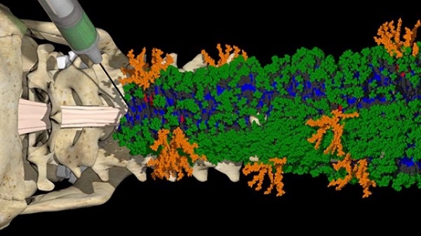 Molekulový model novej injekčnej matrice z nanovlákien obsahujúcej zhluky dvoch peptidov (zelený a oranžový), ktoré spúšťajú kaskádové signály na opravu poškodenia miechy.