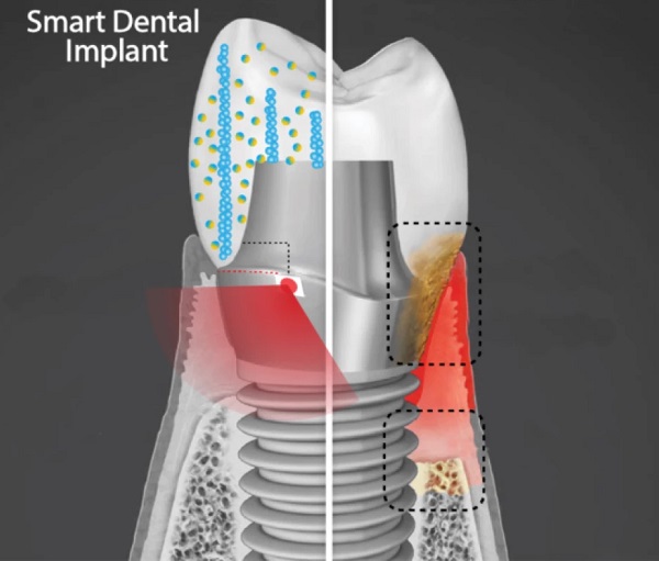Schéma rezu inteligentného zubného implantátu, ktorý existuje ako prototyp fyzického dôkazu funkčnosti konceptu.