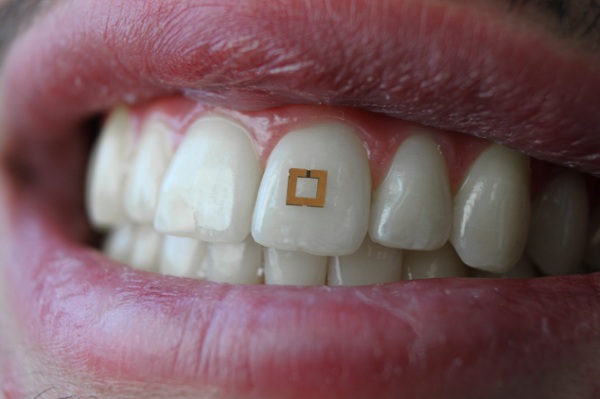 Vedci z univerzity Tufts v Massachusetts navrhli RDIF senzor, ktorý na zube deteguje príjem glukózy, soli a alkoholu.