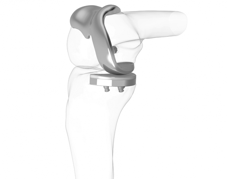 3D kolenný kĺb