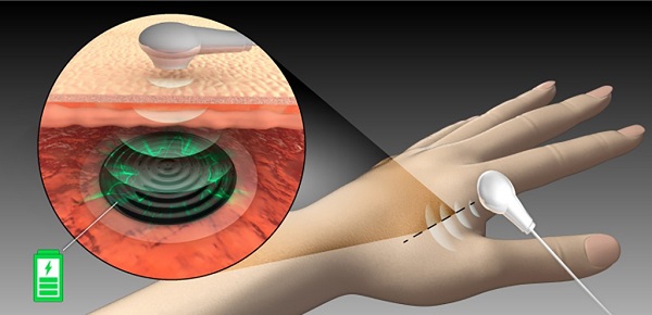 Ilustrácia nabíjania biologicky kompatibilnej batérie pomocou ultrazvuku.