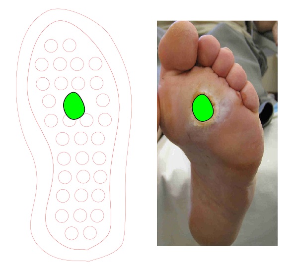 Špeciálna vložka do topánok pre diabetikov pomáha s liečbou vredov na nohe.